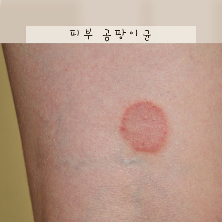 피부 곰팡이균 원인 종류 및 치료 연고, 발톱 손톱 사타구니 어우러기 백선증 전염 : 네이버 블로그