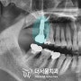 모란역 치과 에서 알려드리는 '큰 어금니의 소중함' 구치부 디지털 임플란트 (with sinus 뼈이식)