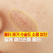 손톱에 긁힌 흉터 제거 수술까지 자국이 남았던 케이스를 치료한 사례입니다. (로담한의원 새살침 후기)