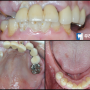 전체 치아 상실, 자연치 기능 회복을 위한 화곡동 치과 부분 틀니 및 임플란트 식립 후기