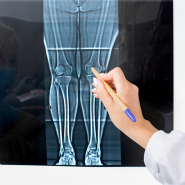 무릎 부음 인대 늘어남 증상 수술을 안해도 된다?