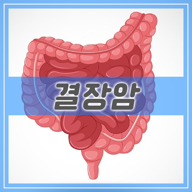 결장 내막의 악성 종양 결장암 : 네이버 블로그