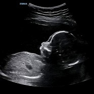 콩의 아기 콩닥❤️ 임신 17주-20주ㅣ임신 5개월 차 증상ㅣ임신 17주부터 느껴진 첫 태동 느낌