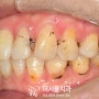 성남 치과 잇몸 내려감 치경부 마모증 및 파절 시린이 치료 증례 (크라운, 레진, GI)