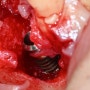 임플란트 뼈이식 꼭 필요한건가? 골이식 이유 와 내용 인천 부평 굴포천역 치과 에서 자세히 설명드립니다