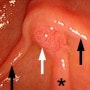 십이지장 속의 유두 주위 게실과 (periampullary diverticulum) 급성 췌장염(전문 지식)