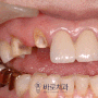치아가 빠졌을때 방치하지 말고 광주양산동치과 치료 필요한 이유