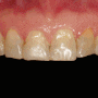 앞니 색 변함, 치아 사이 충치 범계 치과 에서 자연스럽게 해결해 드린 증례(feat. 실활치 미백, 심미보철 과정)