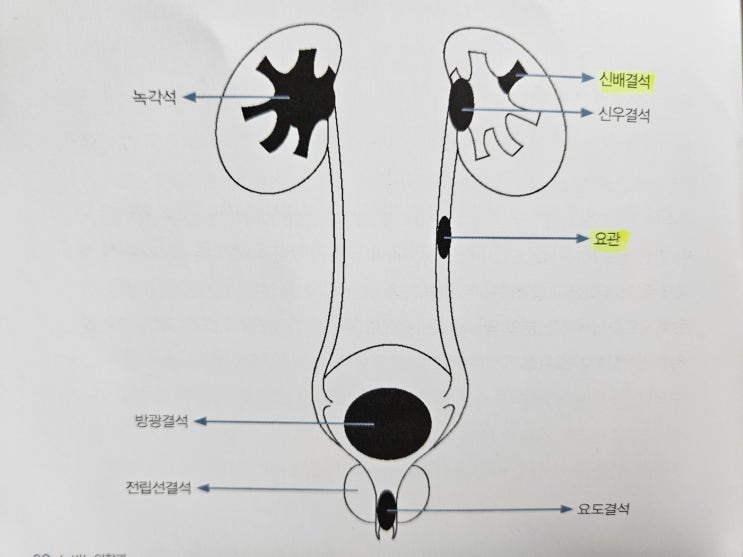 요로결석 수술 후기_요관경하 쇄석술, 요로결석 통증, 요로결석 원인, 증상과 치료, 예방법, 요관출혈 : 네이버 블로그