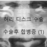 허리 디스크 수술의 합병증 -1-