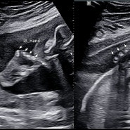 콩의 아기 콩닥❤️ 임신 22주-24주ㅣ임신 6개월 차 증상ㅣ인정병원 2차 기형아 검사 정밀 초음파 후기