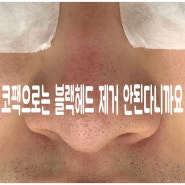 코팩으로는 블랙헤드 제거 안된다니까요