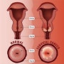 자궁경부세포검사 반응성세포변화가 자궁암이 될 수 있다는 뜻인가요? 자궁경부암 검사를 다시 해봐야 하는 것인가요?