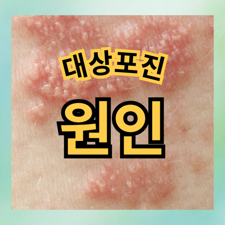 대상포진 초기증상 원인 얼굴 눈 엉덩이, 예방접종 종류 : 네이버 블로그