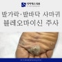 발가락 발바닥사마귀 블레오마이신 주사치료 효과, 울산사마귀병원