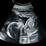 [임신 일기] 7화. 임신 중기 22주 정밀초음파를 하다