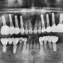 송정동 치과 상악동 거상술 부작용 없이 임플란트 뼈이식 식립 과정 진행 사례