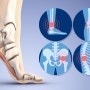 발뒤꿈치 통증 유발하는 족저근막염 치료 없이 장기간 방치할 경우