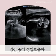 임신20주~23주차 정밀초음파 , 태아 부정맥 대학병원 소견서
