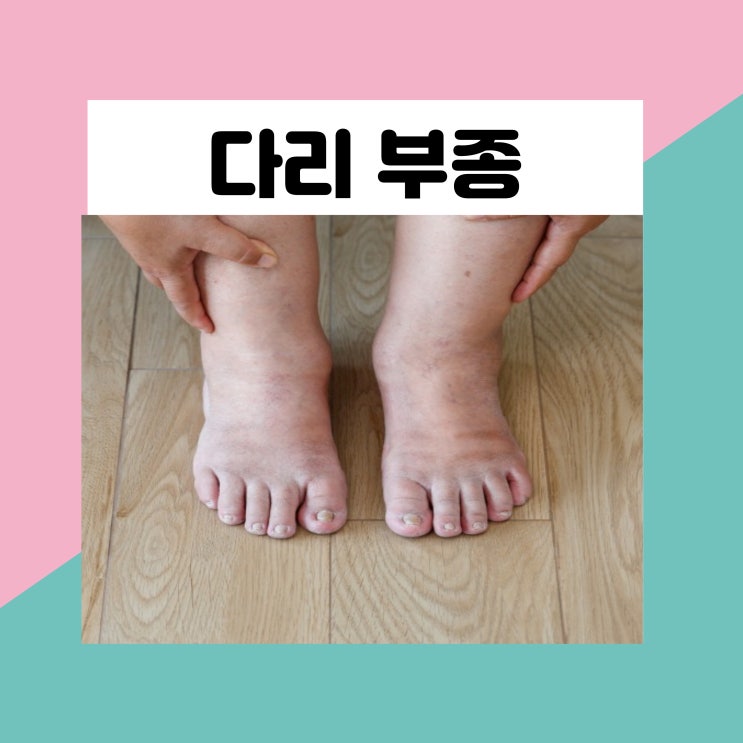 다리 부종 증상과 원인 10가지 및 다리가 붓는 이유 : 네이버 블로그
