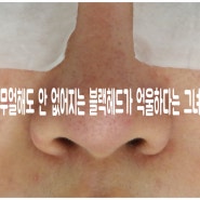 무얼해도 안 없어지는 블랙헤드가 억울하다는 그녀