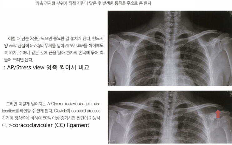 [어깨] ACCC injury 견봉인대 관절 손상 (AC Joint ligaments +/- coracoclavicular CC ...