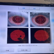 렌즈삽입술#3 한달 차 내돈내산 후기(그런데 난시 재교정을 곁들인..) 각막혼탁 잔여 난시 부작용, 한쪽 눈 흐릿한 증상