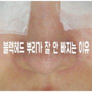 블랙헤드 뿌리가 잘 안 빠지는 이유