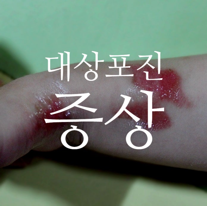 마곡동내과 대상포진 수포 발진 증상 나타났다면 : 네이버 블로그