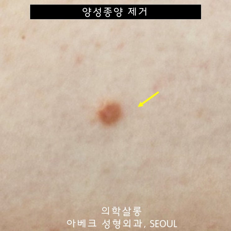 허벅지 섬유종 / 종아리 섬유종 제거 수술 후기 【Dr. 아베크 양성종양】 : 네이버 블로그