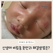 신생아 비립종 코에 오돌토돌 원인과 해결 방법은?