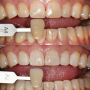 기존 치아에 치료가 되어 있으면 미백 치료는 어떻게 할 수 있나요? 송도 치과 추천