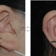 귀켈로이드 수술 사진 200