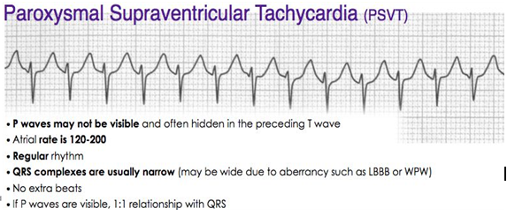46. PSVT: Proxymal SupraVentricular Tachycardia : 네이버 블로그