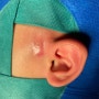 선천성 귀 주변 작은 구멍 ‘이루공’- 염증이 반복된다면? (논문 리뷰)