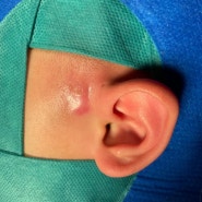 선천성 귀 주변 작은 구멍 ‘이루공’- 염증이 반복된다면? (논문 리뷰)