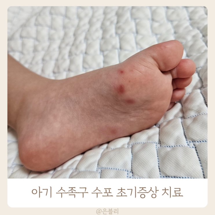 아기 수족구 수포 초기증상 치료 : 네이버 블로그