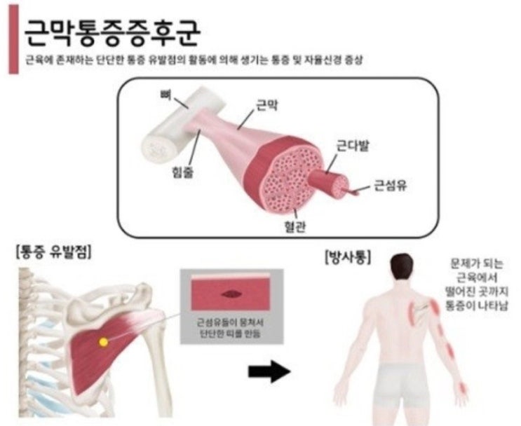 근막통증 증후군 : 네이버 블로그