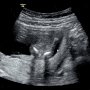 [임신16주차]16주 2차 기형아검사후기,증상,성별확인,배크기,체력