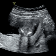 [임신16주차]16주 2차 기형아검사후기,증상,성별확인,배크기,체력