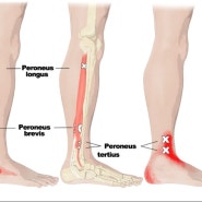 알통 Series 4 - 발목 통증(foot pain) : 제 3비골근(Peroneus tertius)