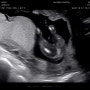 [임신 15주~16주차]16주차 초음파┃2차 기형아검사┃태아 성별은 ?
