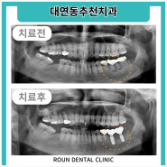 대연동추천치과, 정기적인 검진이 중요해요!