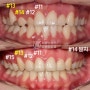 치아 전위 (transposition), 송곳니와 작은 어금니 위치가 바뀌어 자랐다?! 시흥치과 교정으로 개선 완료👍🏻