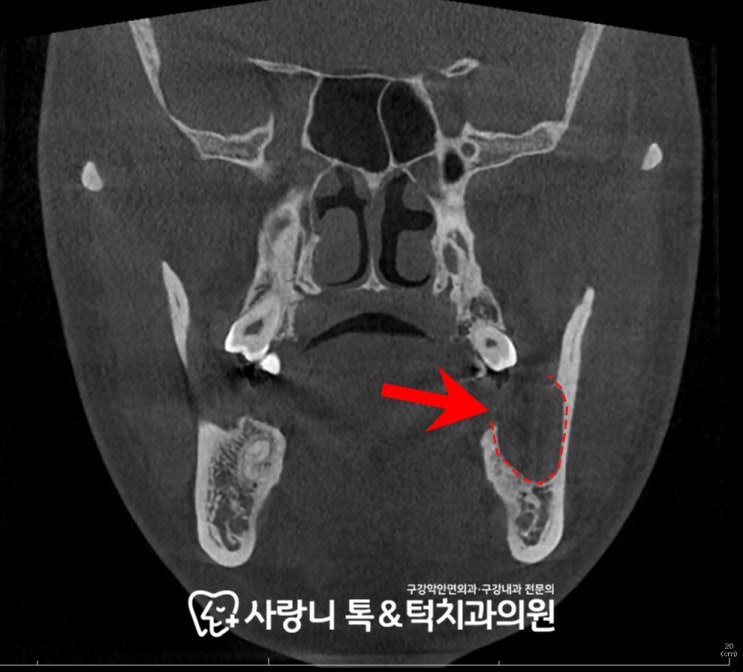 구강 신경섬유종(Oral neurofibroma) 종양 제거술 가능한 영통역 치과 : 네이버 블로그