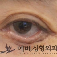 하안검부작용 안검외반 눈밑 치료방법은?