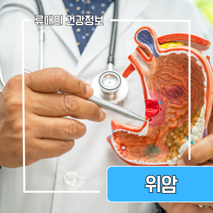 위암 초기증상 원인 위암 말기증상 전 위암 1기, 4기 정리 : 네이버 블로그