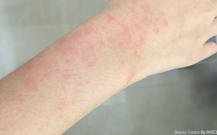 햇볕알러지 팔 햇빛 알레르기 증상 피부 따가움 화끈거림 연고 : 네이버 블로그