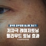 김천 헐리우드스펙트라(헐리우드토닝)_톤과 결을 동시 개선