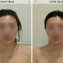 끌리메 청주점 :: 청주피부관리 작은얼굴 윤곽관리 1회차 후기 (Before & After)